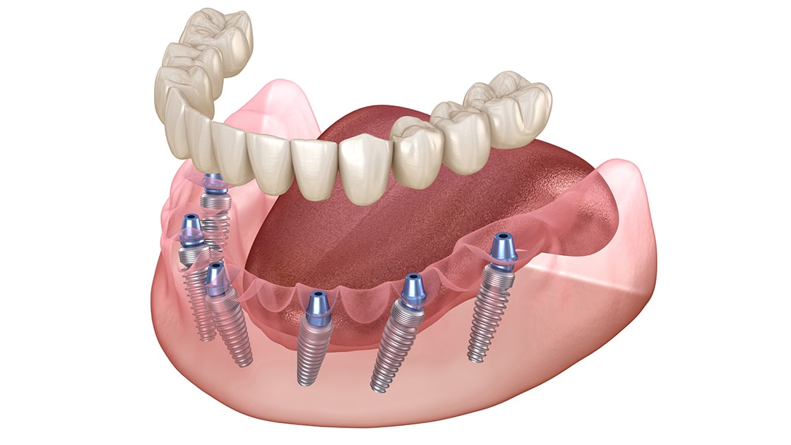 Implant Supported Denture